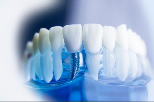 Особенности томографии при наличии зубных протезов