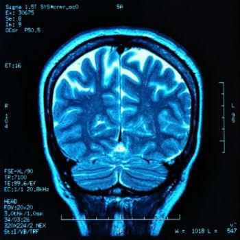 снимок МРТ мозга