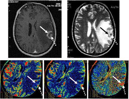 МРТ головного мозга с контрастом